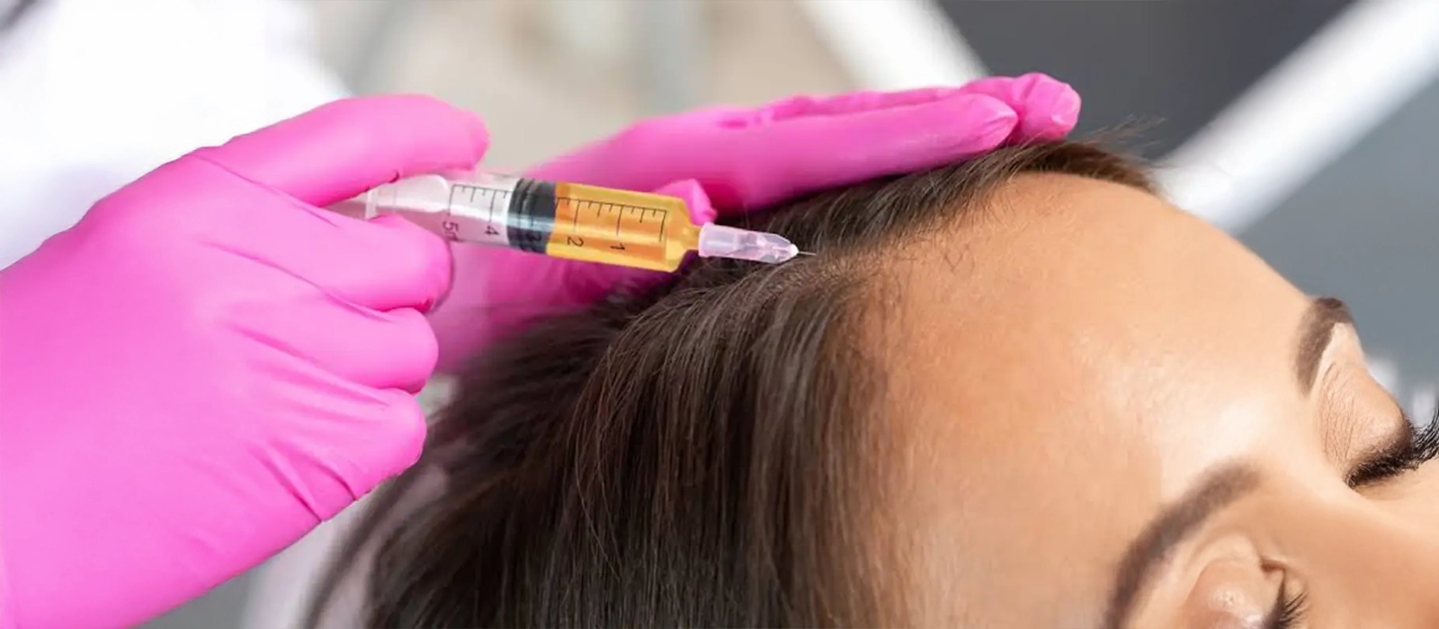 Trapianto di Capelli con Cellule Staminali