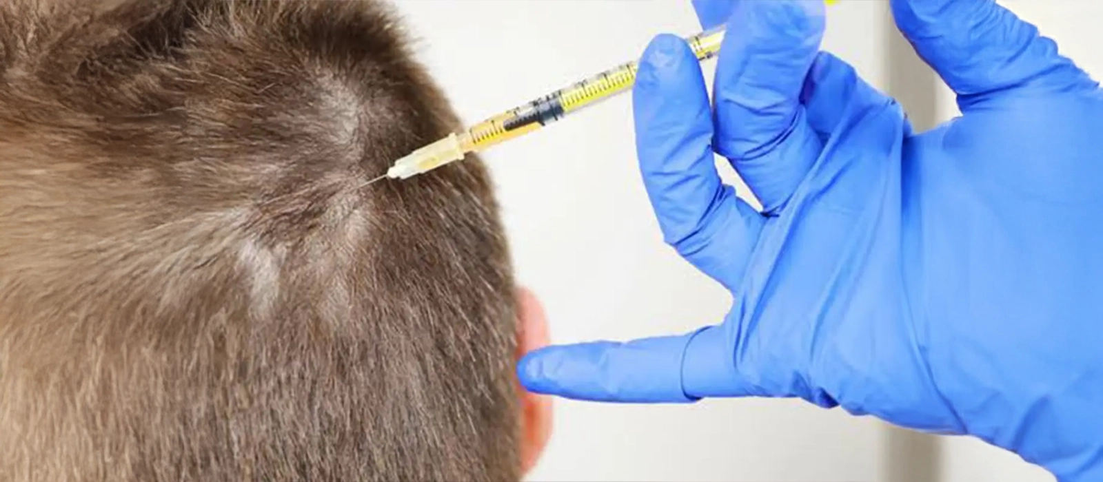 Trapianto di Capelli con Esosomi