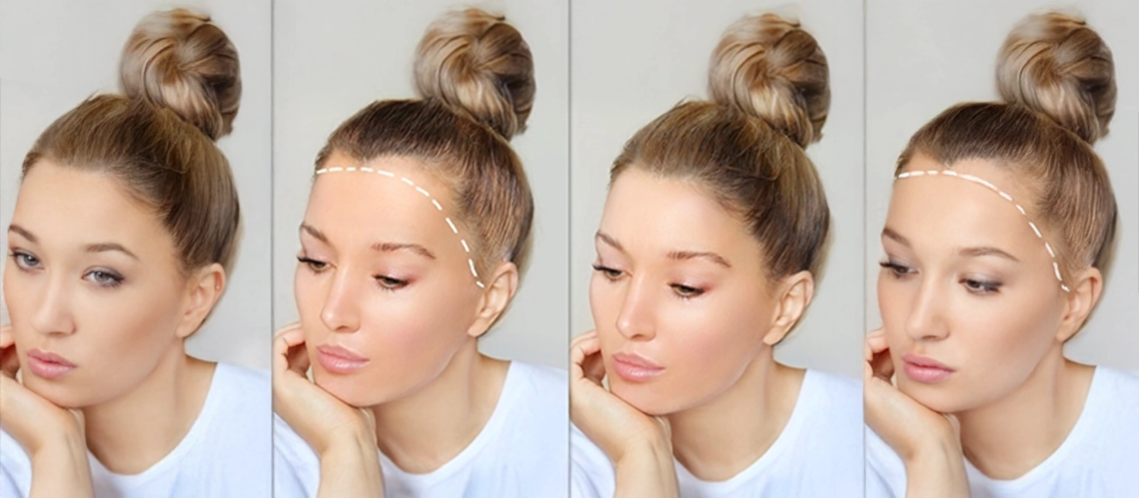 No Shave Female Hair transplant