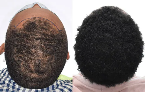 Trapianto di Capelli Afro