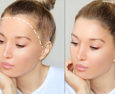 No Shave Female Hair transplant