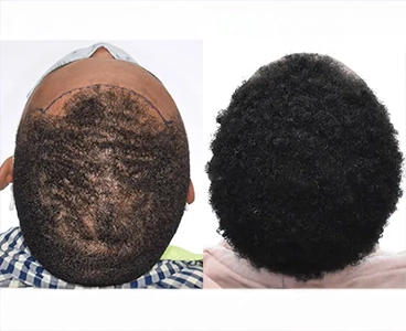 Afro Hair Transplant
