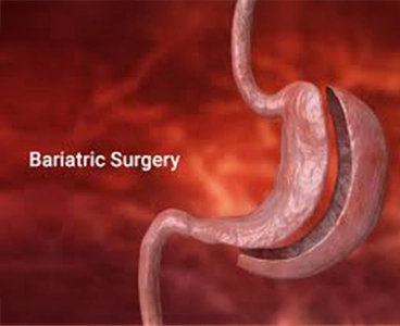 Bariatric Surgery